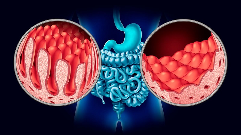 Enfermedad celiaca 1